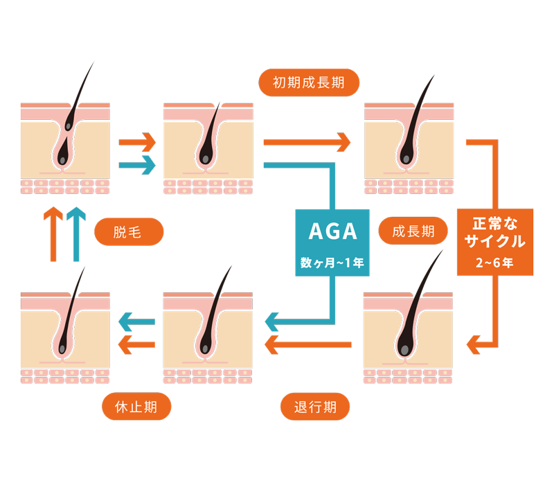 正常な毛周期とAGAの毛周期の違い。正常は成長期が2〜6年、AGAは数ヶ月〜1年に短縮する様子を示す図