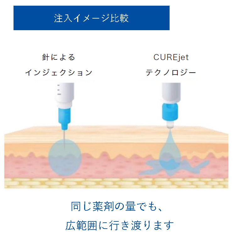 針によるインジェクションとCUREJetテクノロジーの薬液到達範囲の比較図。同じ量でも広範囲に行き渡る様子を示す
