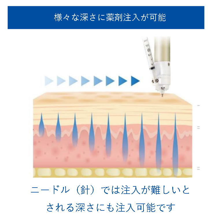 様々な深さへのドラッグデリバリーを示す模式図。針では注入が難しい深さにも到達できる様子を説明
